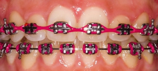Orthodontic Ligatures/o-ties with power chain