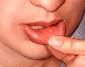 Mouth sores