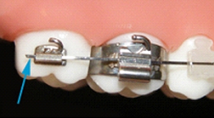 Poking archwire